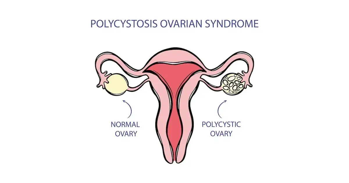 schemat jajników policystycznych, zaburzenia hormonalne tarczycy