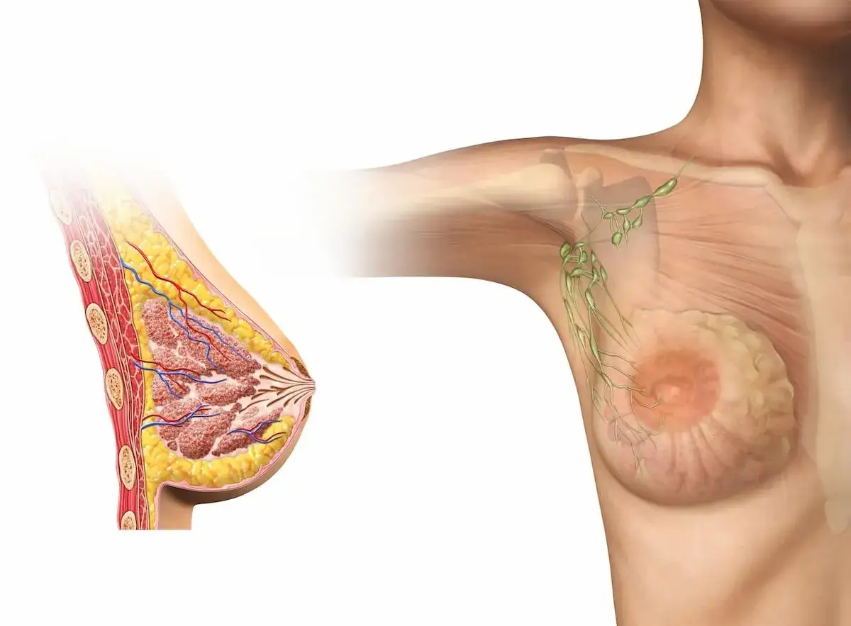 Brustgewebe und Lymphknoten im Achselbereich. Die Darstellung zeigt, wie metastasierter Brustkrebs sich ausbreiten kann.