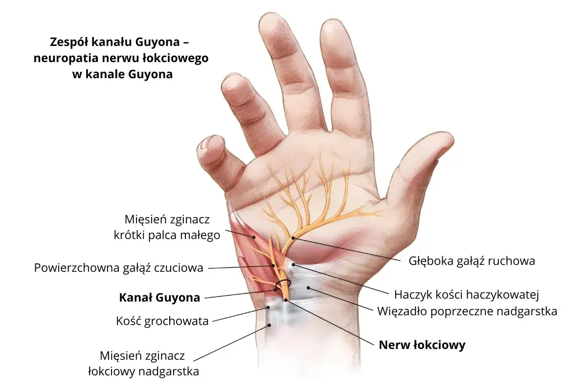 Anatomia dłoni z zaznaczonym nerwem łokciowym i kanałem Guyona, ilustracja medyczna. Kod choroby G56.