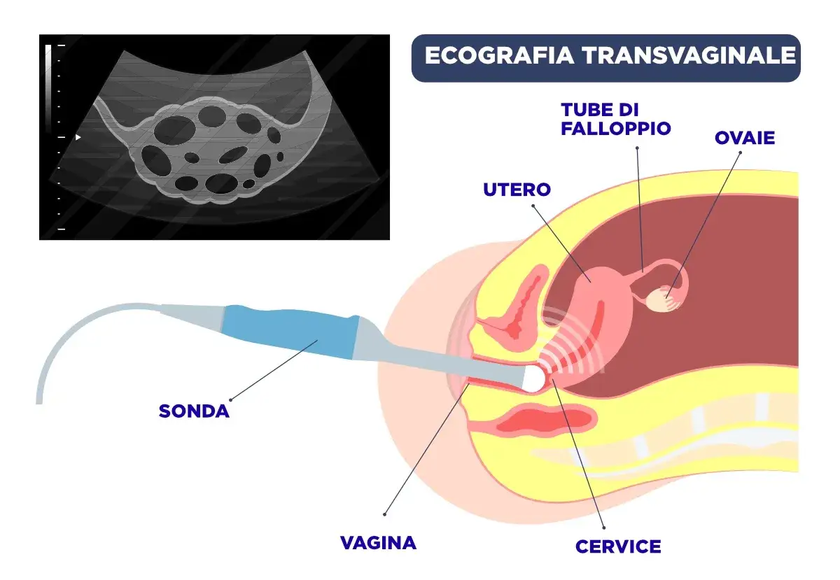 Ecografia transvaginale: sonda, utero, ovaie, tube di Falloppio. Il metodo Ramzi analizza la posizione dell'embrione per predire il sesso.