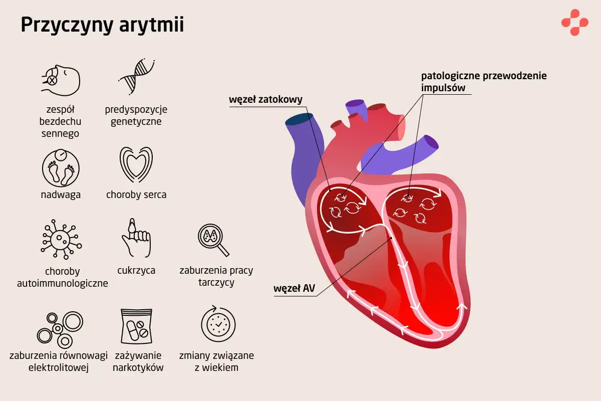 Ilustracja przedstawia przyczyny arytmii, w tym nieregularne bicie serca spowodowane m.in. chorobami serca, cukrzycą, zaburzeniami pracy tarczycy, czy zmianami związanymi z wiekiem.