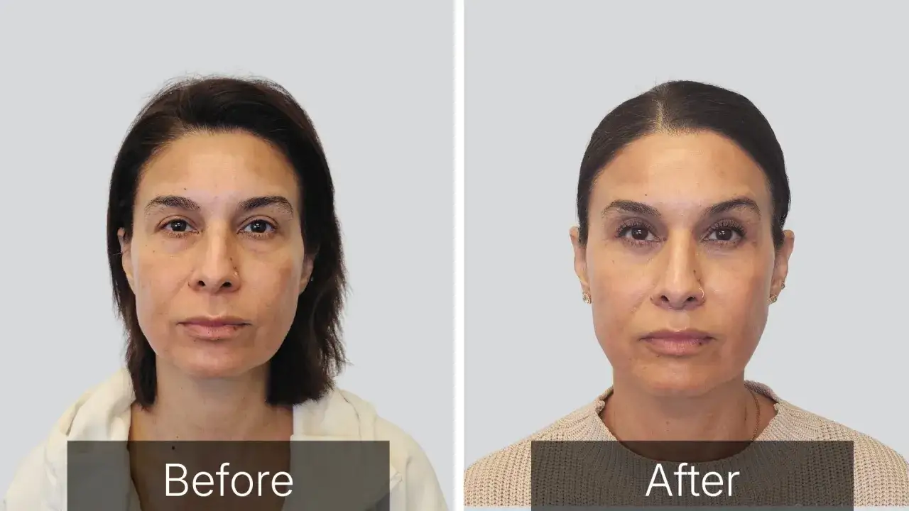 F&ouml;re- och efterbilder visar en kvinna som genomg&aring;tt en brow lift. Hennes &ouml;gonbryn ser lyftare och mer definierade ut efter ingreppet.