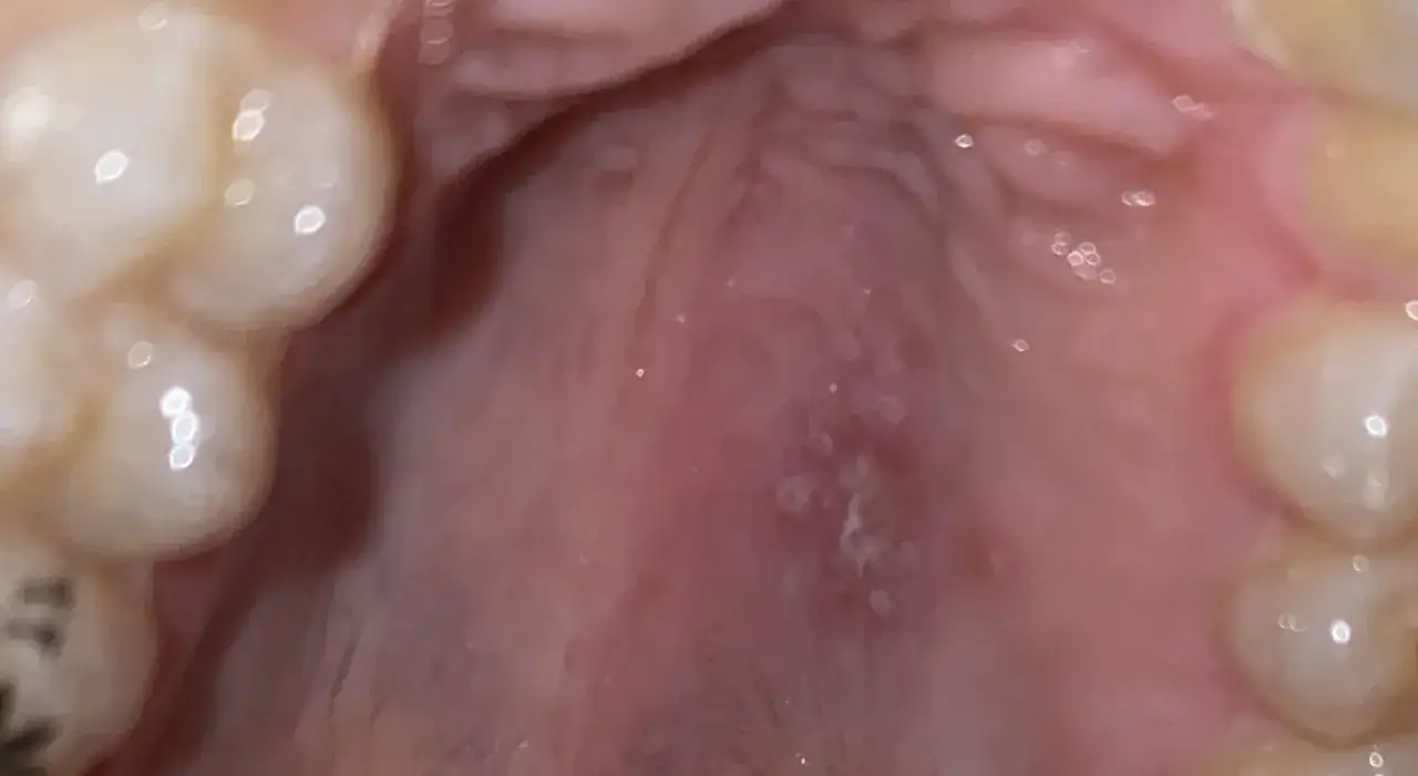 Paladar con peque&ntilde;as llagas y enrojecimiento. Los ataches me hacen heridas, se ven los dientes y la lengua.