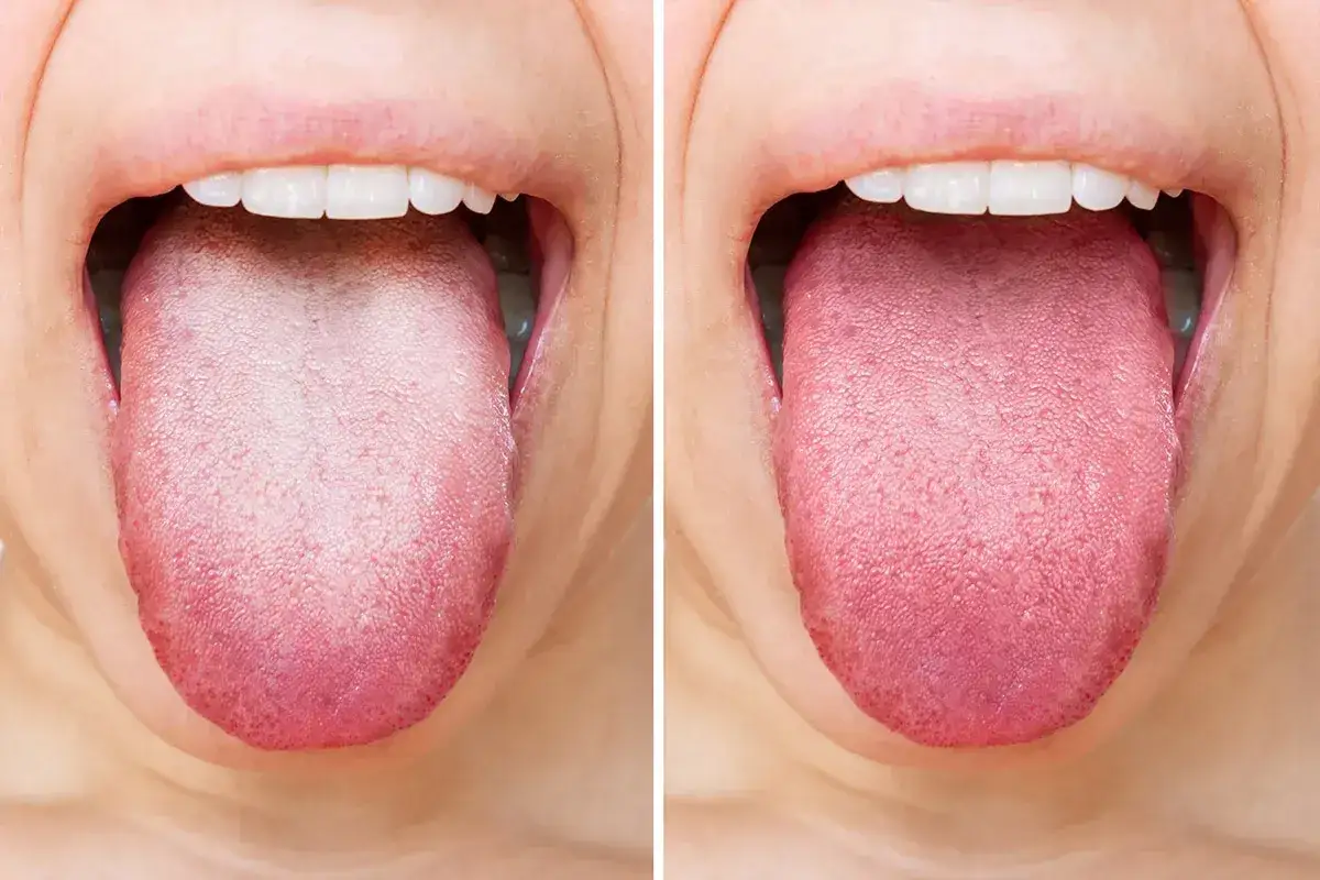 Lingua bianca e patinata, sintomo di bocca amara, a confronto con una lingua sana e rosa.