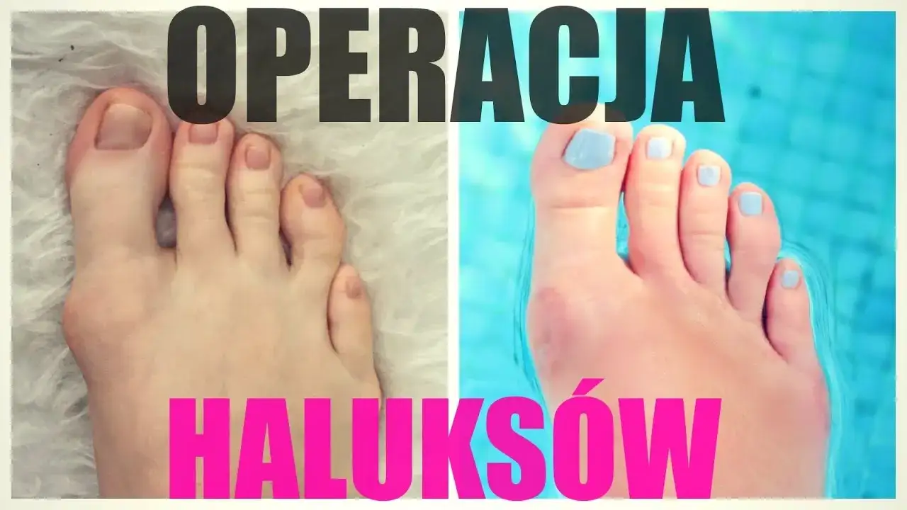 metody operacji haluksów porównanie