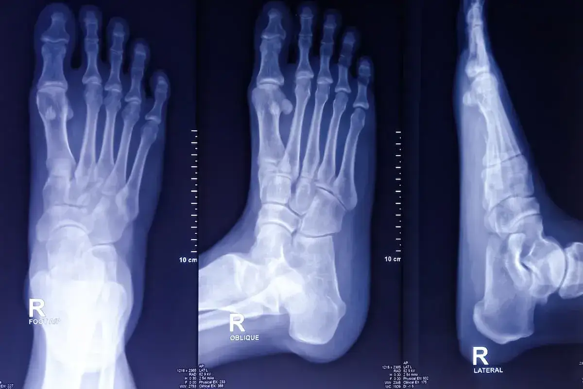 Radiografie del piede destro mostrano una frattura non consolidata con sintomi evidenti, come la deformit&agrave; del metatarso.