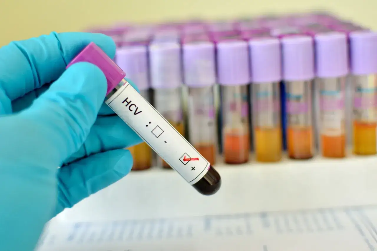 Rękawiczka w niebieskiej rękawiczce trzyma probówkę z oznaczeniem HCV. Wynik badania jest pozytywny.