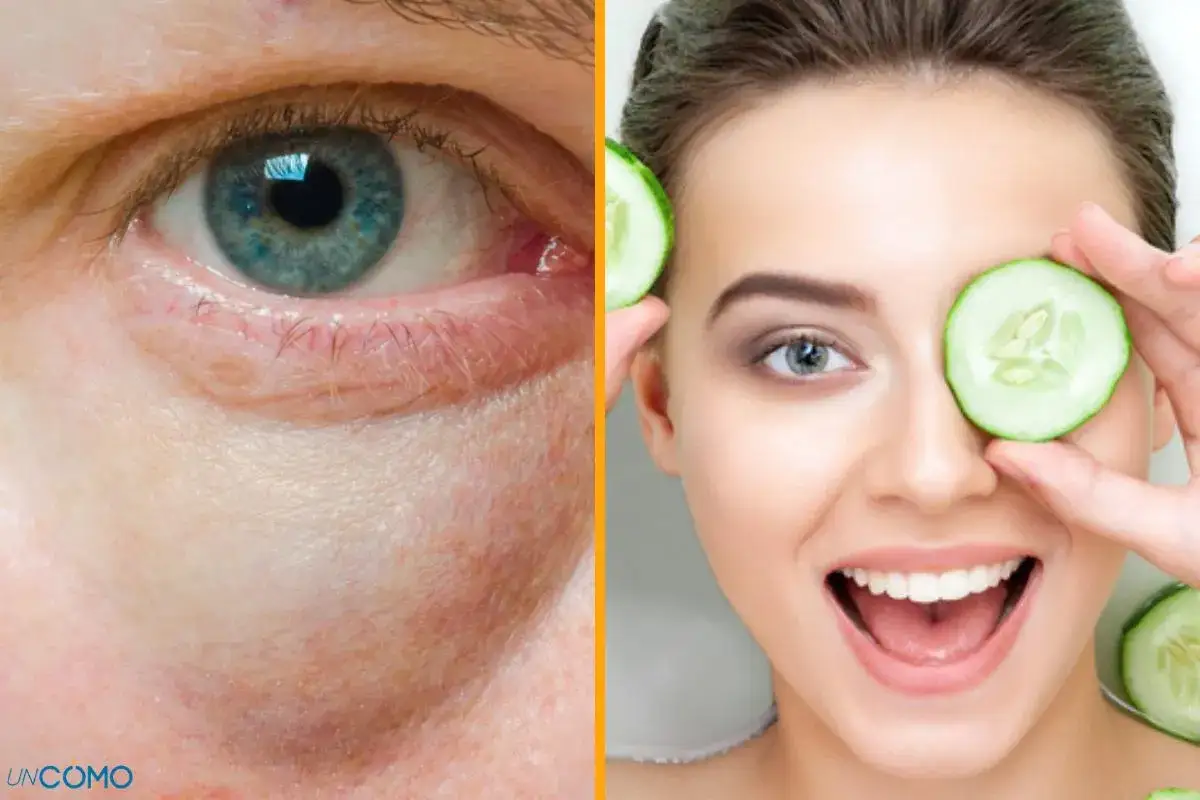 Ojo con bolsas y ojeras, y una mujer sonriente con rodajas de pepino, mostrando remedios caseros para las bolsas en los ojos.