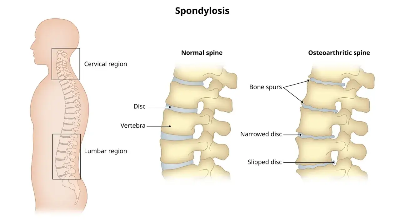 Illustration visar spondylos i nacken och ländryggen. Jämför normal ryggrad med osteoartritisk ryggrad med benpålagringar och förträngda diskar.