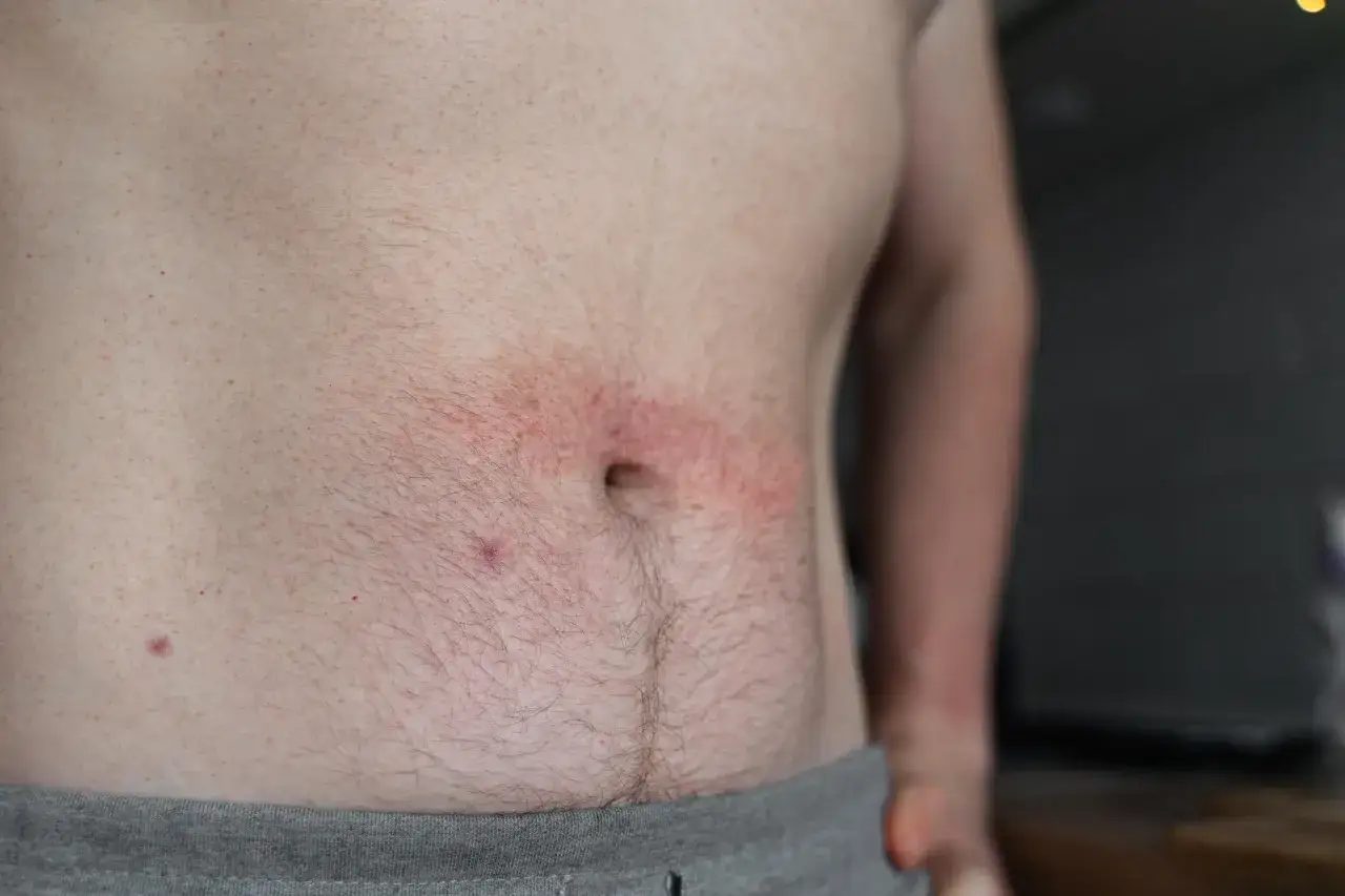 Un ventre qui gratte signification : une éruption cutanée rouge et irritée autour du nombril, peut-être due à une allergie ou une irritation.