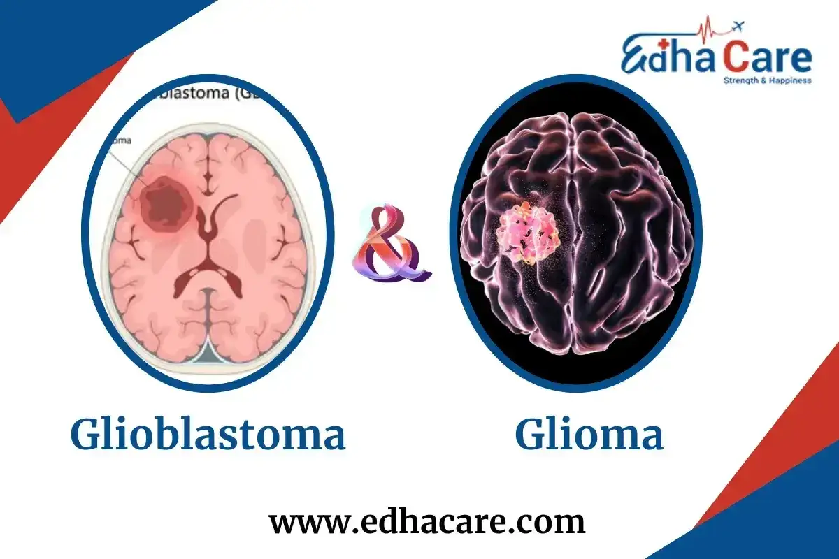 Ilustracje mózgu pokazują guzy: glioblastoma i glioma. Dowiedz się, jak się umiera na glejaka.