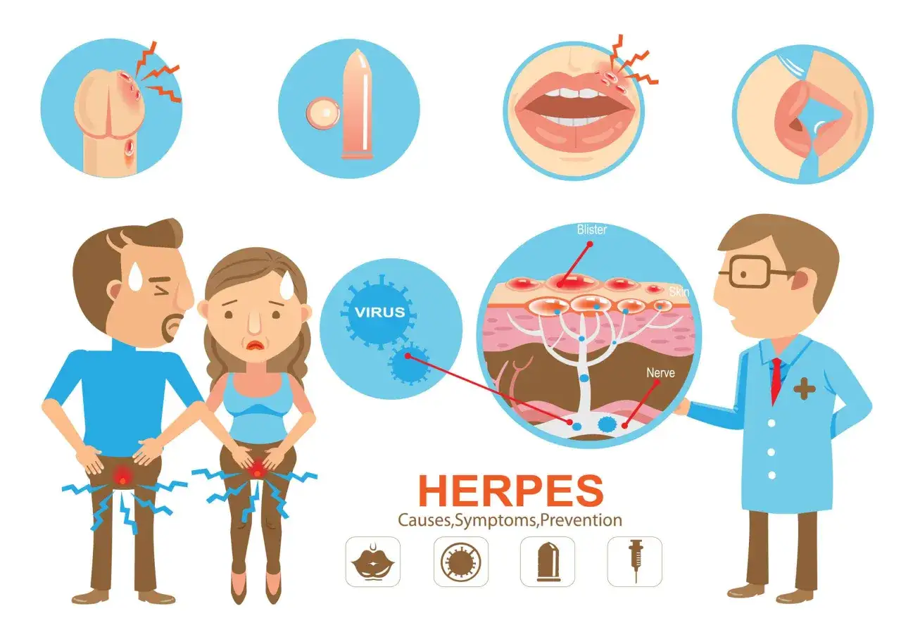 Ilustracja przedstawia objawy i przyczyny herpes, w tym pęcherze na ustach i narządach płciowych, wirusa oraz profilaktykę.