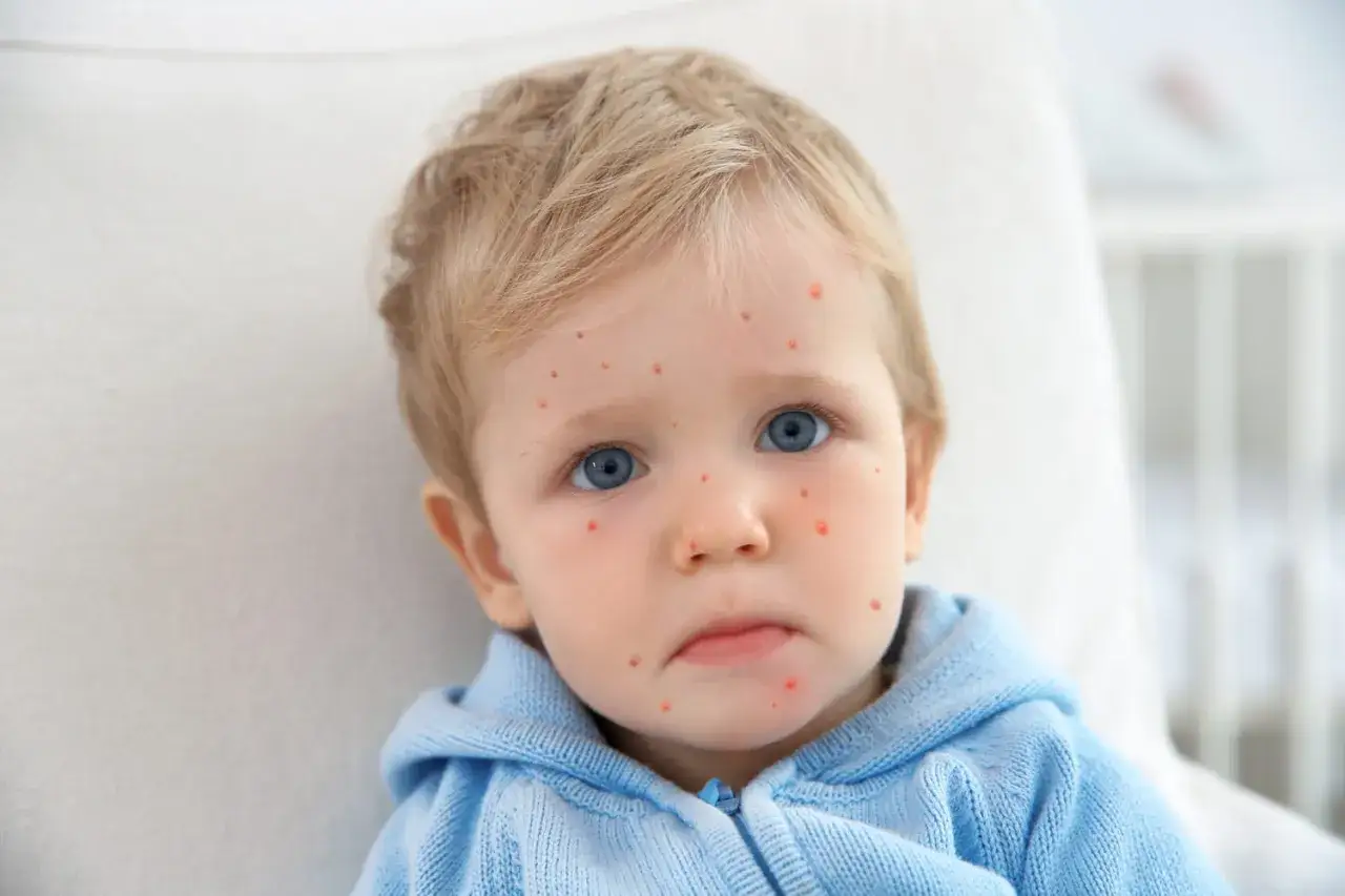 Un petit garçon aux yeux bleus porte un pull bleu. Son visage est couvert de petites taches rouges, signes de la varicelle.