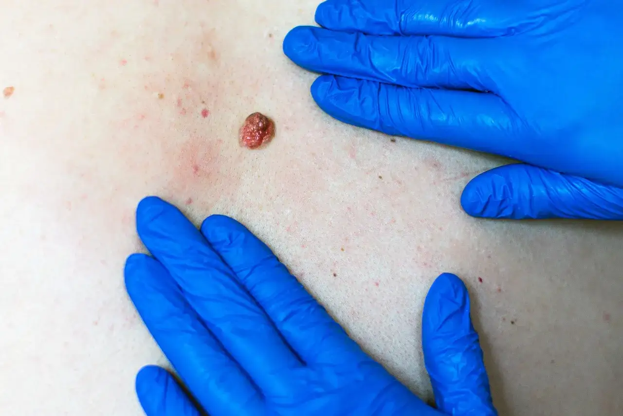 Gros plan sur un bouton qui ne part pas sur la peau, examiné par des mains gantées de bleu.