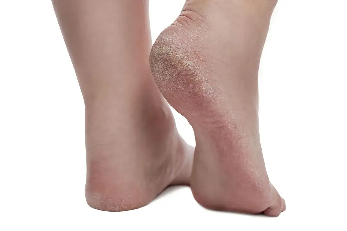Talones agrietados y piel seca, síntomas comunes de la psoriasis en los pies.