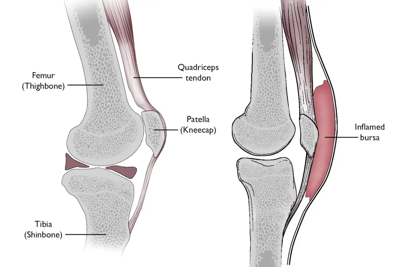 Vergleich von Knieanatomie: links normal, rechts mit entzündetem Schleimbeutel am Knie, der geplatzt zu sein scheint.