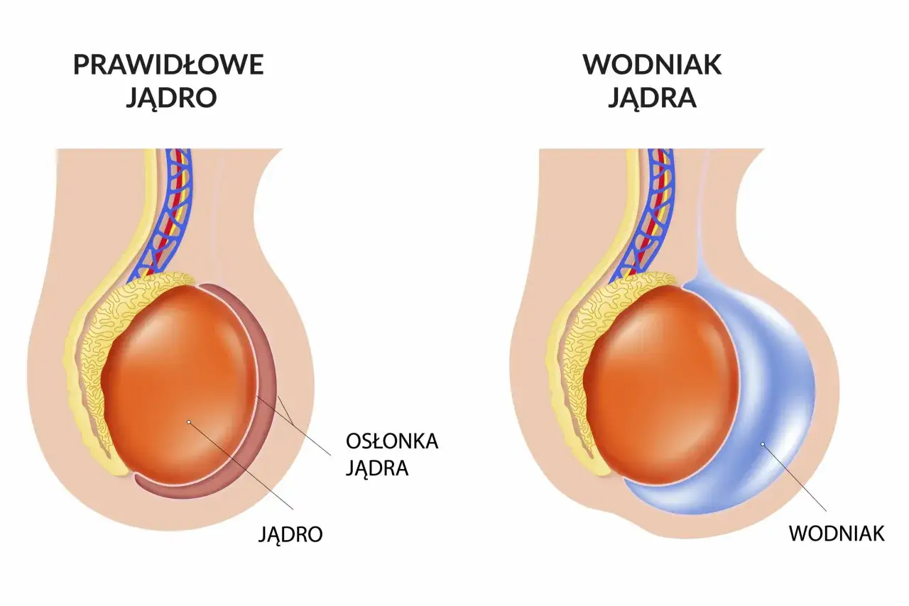 Porównanie prawidłowego jądra z wodniakiem jądra u niemowlaka. Wodniaki jądra u niemowlaka co robić? Obrazek pokazuje nagromadzenie płynu.