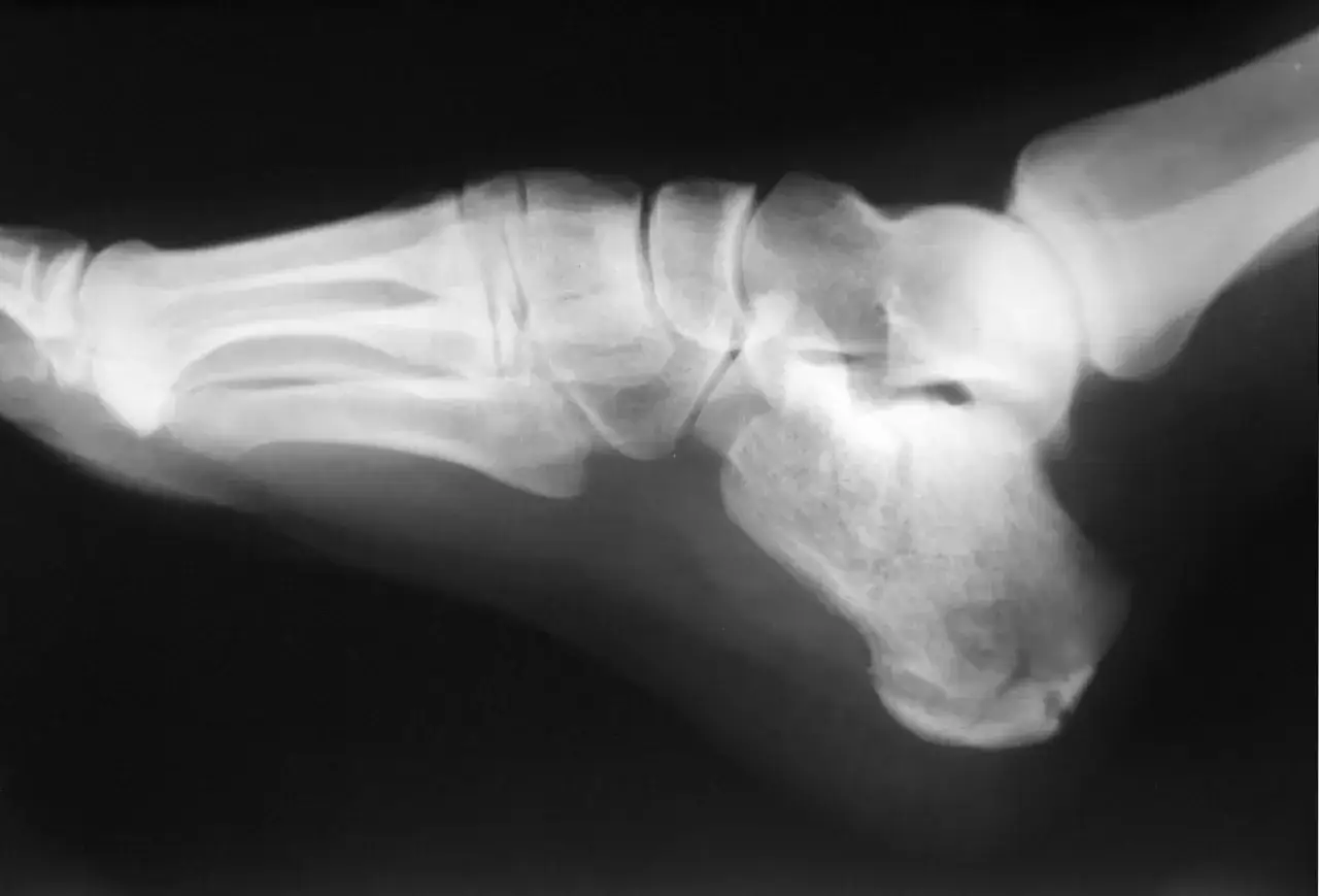 Radiographie latérale du pied montrant une excroissance osseuse au niveau du calcanéum, caractéristique de la maladie de Haglund.