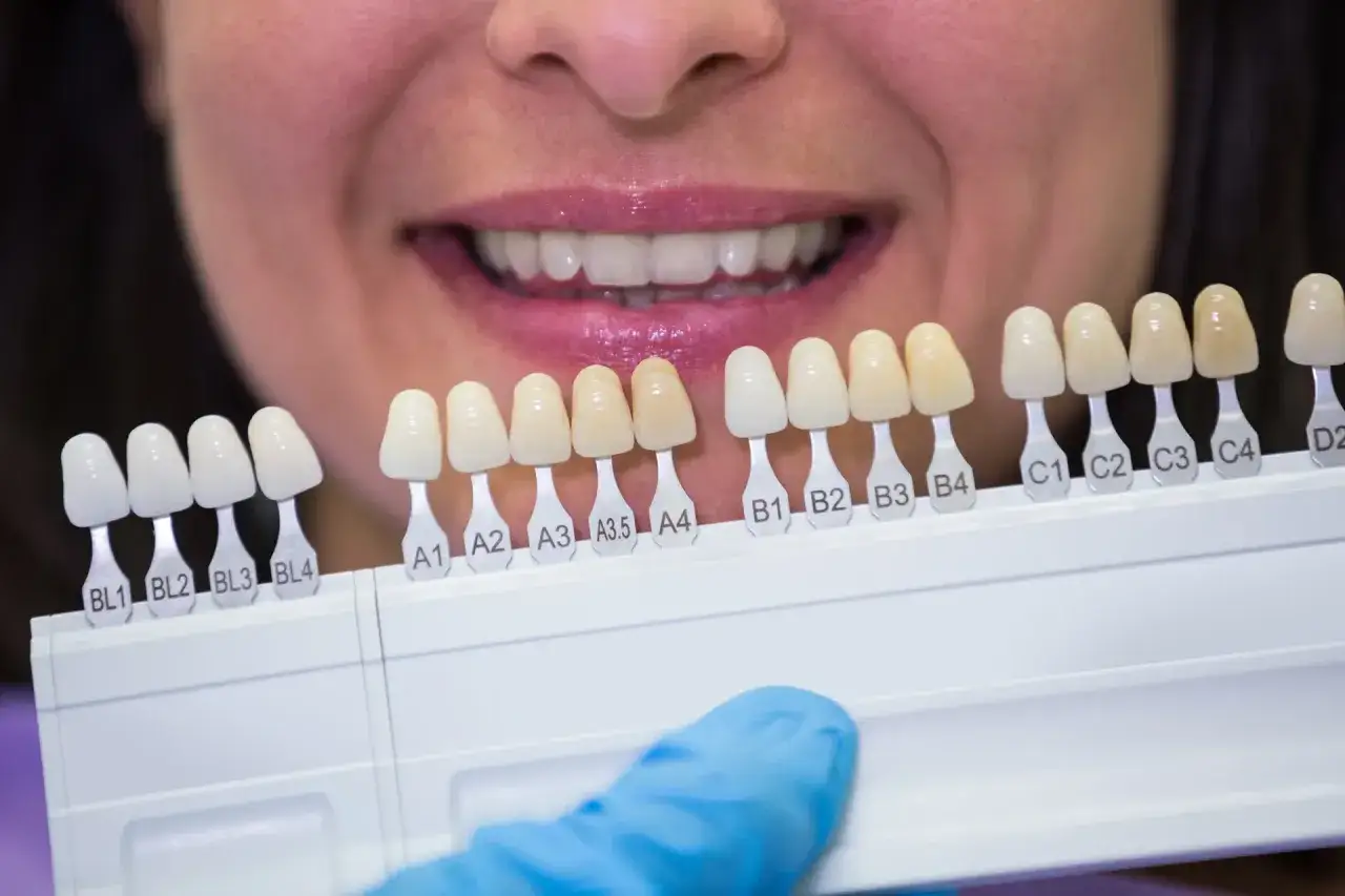 Dobór odcienia licówek kompozytowych a porcelanowych. Paleta kolorów zębów do dopasowania idealnego uśmiechu.