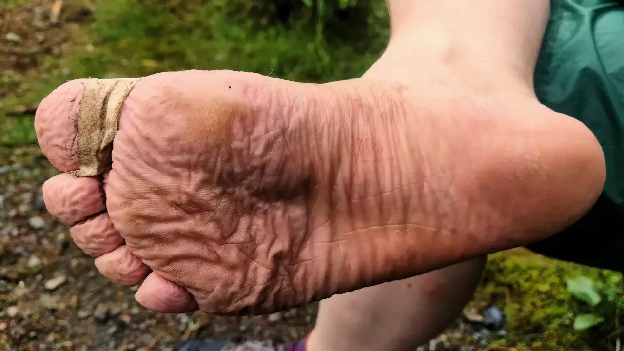 Fu&szlig;sohle mit Blasen, die mit Pflaster behandelt werden. Die Haut ist zerknittert und leicht schmutzig.