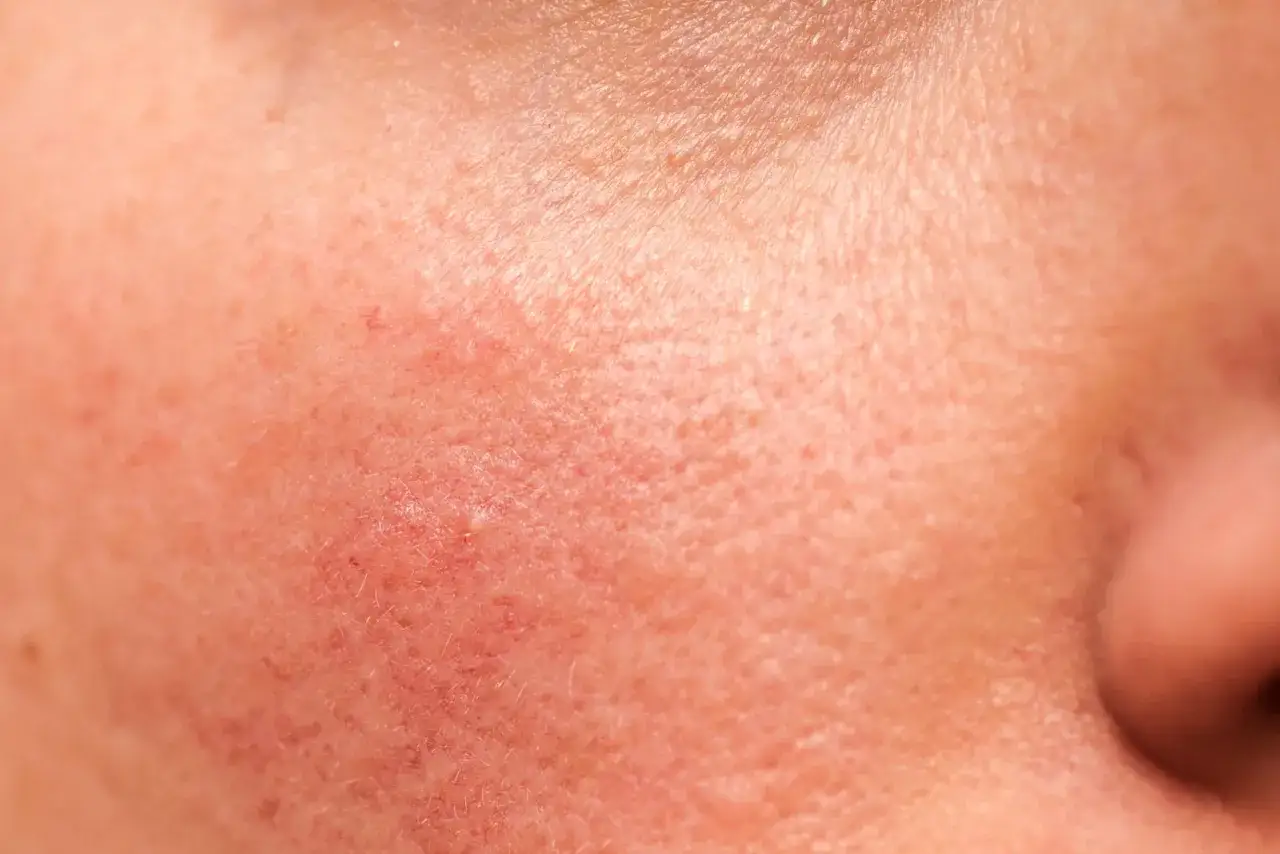 Lekarz dermatolog rozmawiający z pacjentem o alergii sk&oacute;rnej
