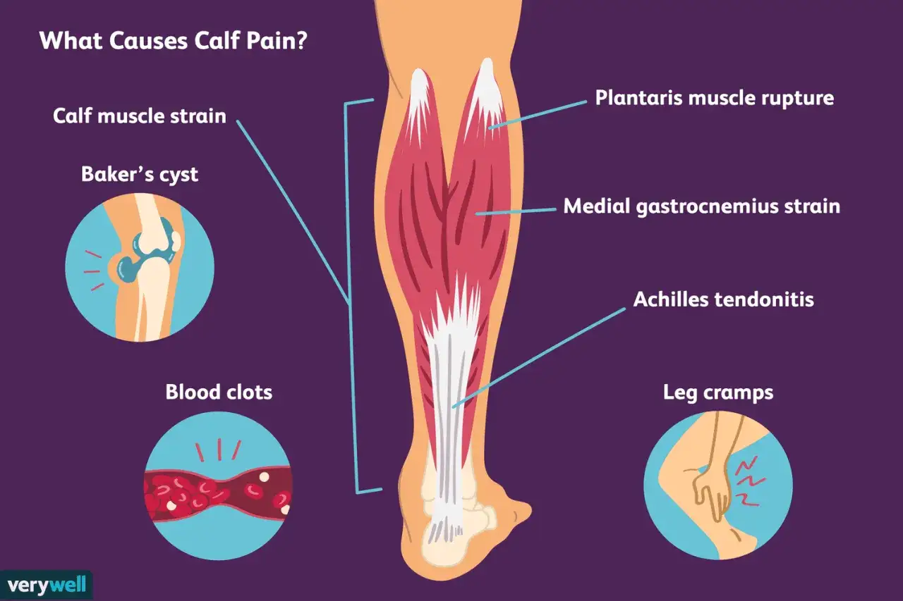 Illustration zeigt Ursachen für Schmerzen in der Wade: Muskelzerrung, Baker-Zyste, Blutgerinnsel, Plantaris-Ruptur, Medial-Gastrocnemius-Zerrung, Achillessehnenentzündung, Wadenkrämpfe.