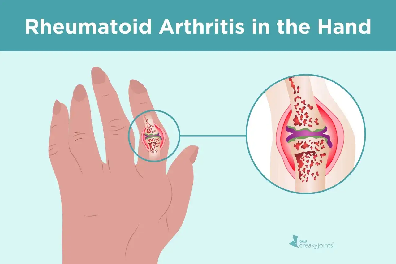 Illustration zeigt eine Hand mit einer vergrößerten Ansicht eines Gelenks, das Entzündungen und Schäden durch chronische Polyarthritis zeigt.