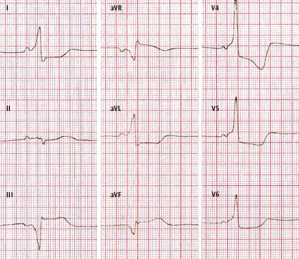 EKG z zaburzeniami repolaryzacji