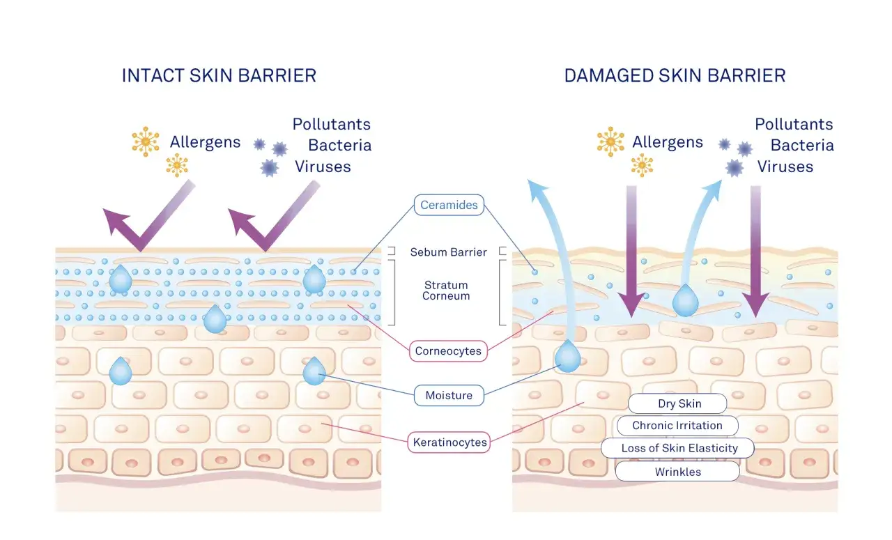 Peau irritée qui brûle : une barrière cutanée endommagée laisse passer allergènes et polluants, causant sécheresse et rides.