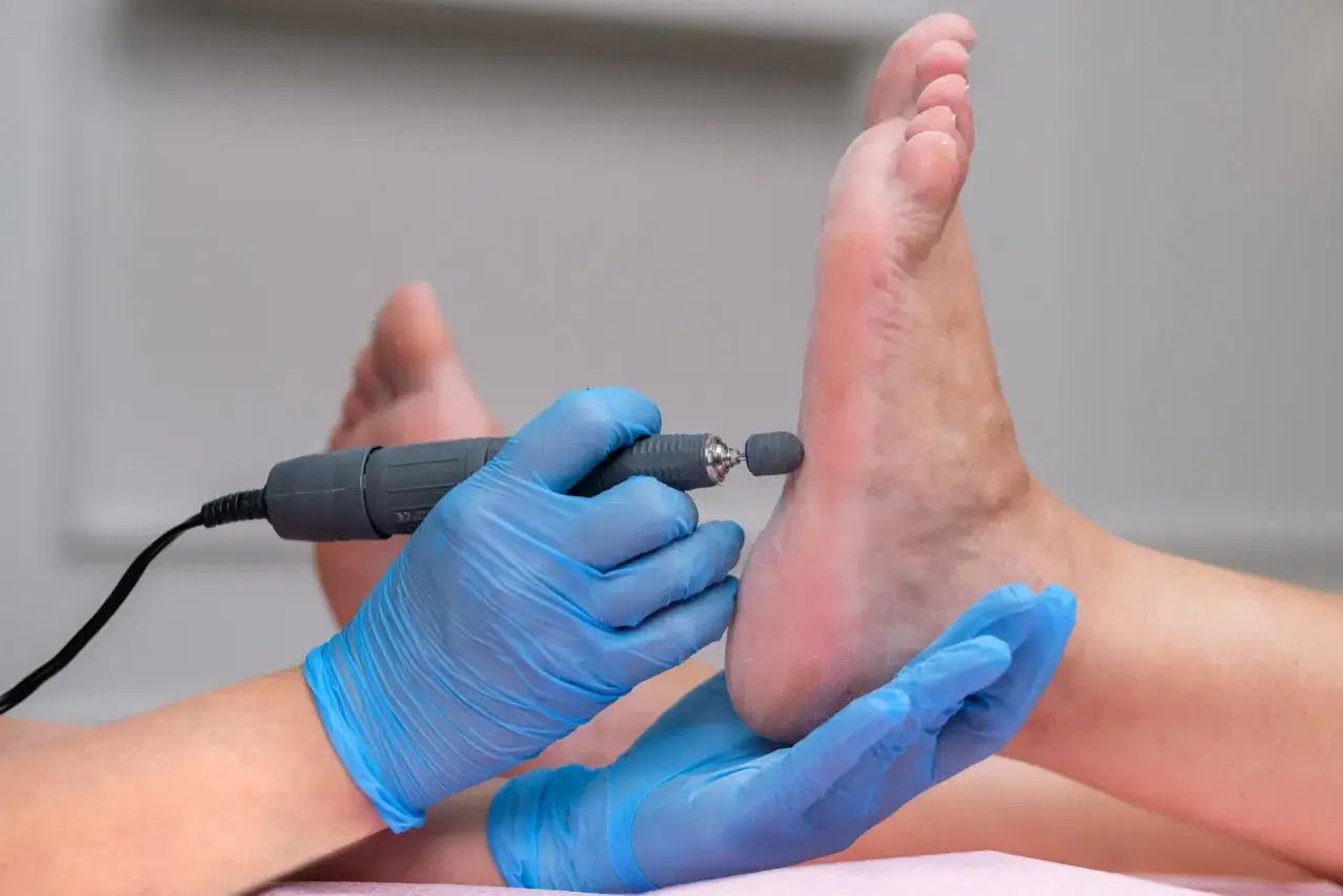 Profesjonalny pedicure z użyciem frezarki, który może pomóc w walce z pękającymi piętami. To jak babcine porady na pękające pięty, ale w nowoczesnym wydaniu.