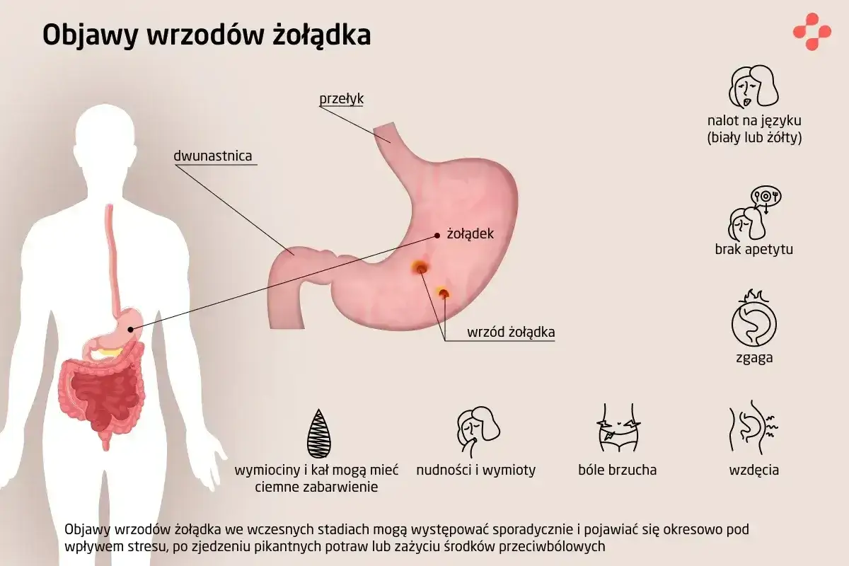 Ilustracja przedstawia żołądek z wrzodami, objawy wrzodów żołądka: nalot na języku, brak apetytu, zgaga, bóle brzucha, wzdęcia, wymioty.