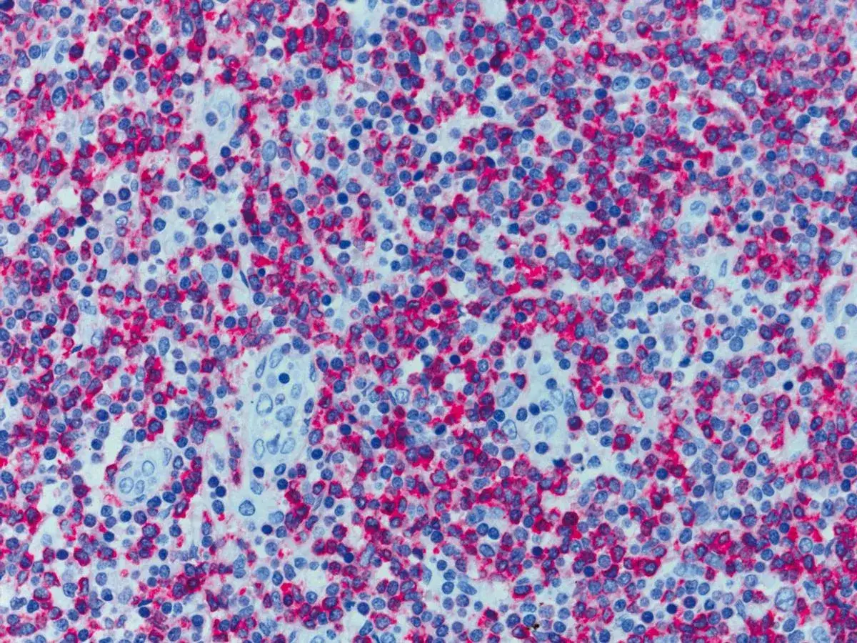 Mikroskopische Aufnahme zeigt einen histologischen Befund mit blau gef&auml;rbten Zellkernen und rot gef&auml;rbten Zellbestandteilen.