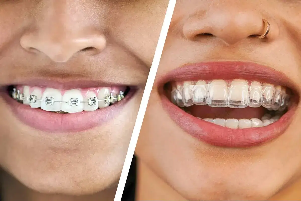 Comparación de ortodoncia: brackets metálicos vs. alineadores transparentes. Aunque los **invisalign duelen** menos que los brackets, ambos tratamientos buscan una sonrisa perfecta.