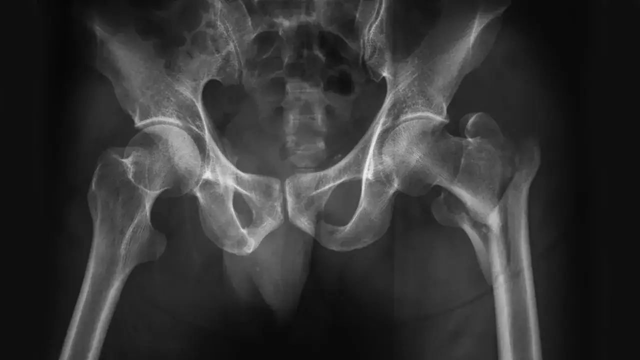 Radiographie du bassin et des hanches montrant un fémur cassé, conséquence d'un traumatisme.