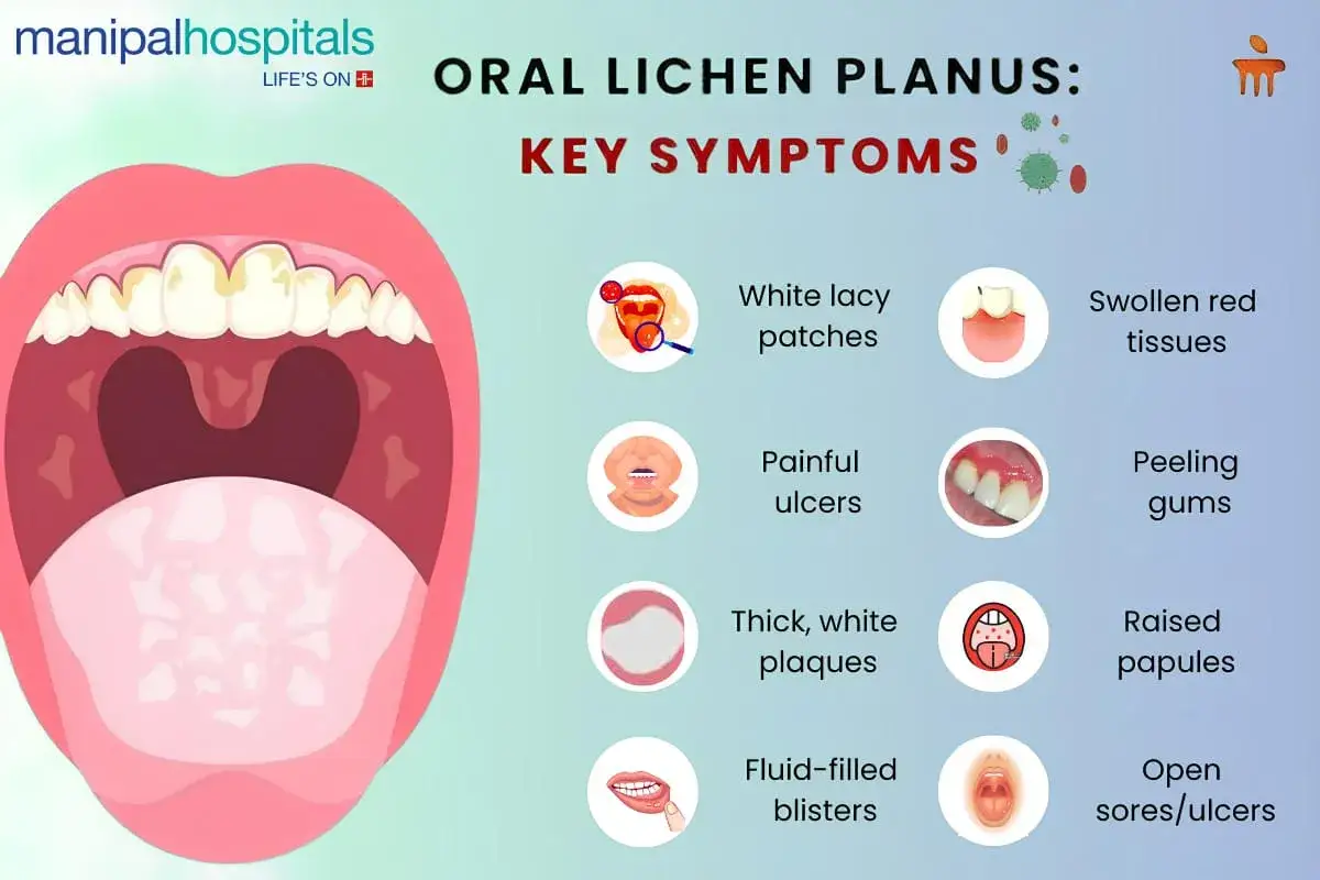 Sintomi del lichen planus orale: placche bianche reticolate, ulcere dolorose, tessuti rossi gonfi. Lo stress può peggiorare il lichen planus da stress sintomi.
