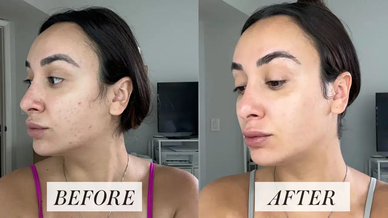 Avant/après : une peau marquée par l'acné avant le traitement, puis une peau plus nette et lisse après l'utilisation d'acide rétinoïque pour le visage.
