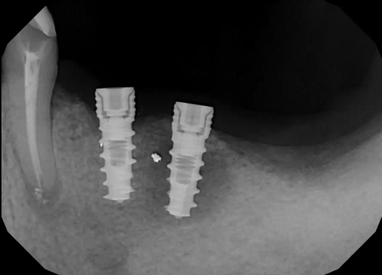 Rentgen szczęki z dwoma implantami. Widoczny stan zapalny przy implancie, co może wymagać leczenia.