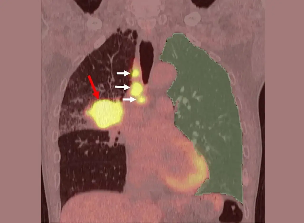 PET-CT zeigt Lungenkrebs-Rezidiv mit hoher Stoffwechselaktivität (rot/weiß Pfeile). Die Lebenserwartung bei Lungenkrebs-Rezidiv ist individuell.