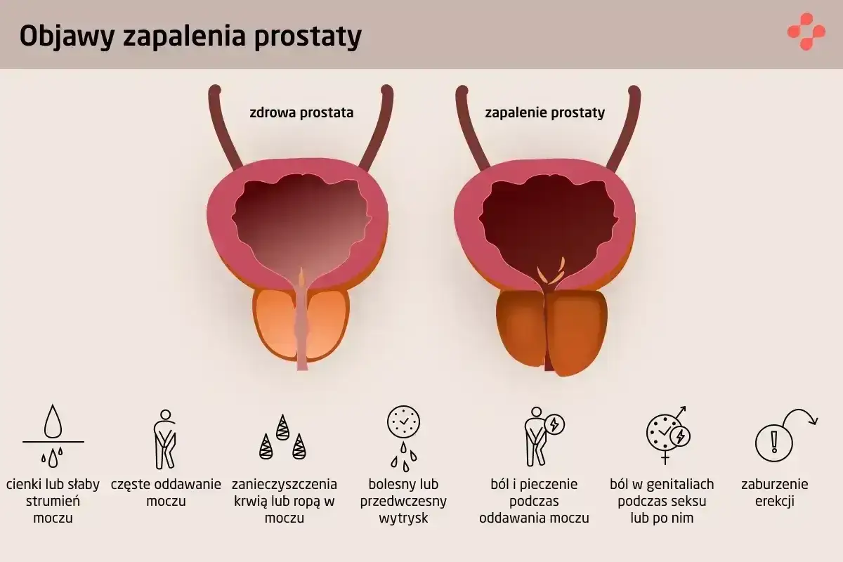 Objawy zapalenia prostaty: ból i pieczenie podczas oddawania moczu, ból w genitaliach, zaburzenia erekcji. Gdzie boli prostata?
