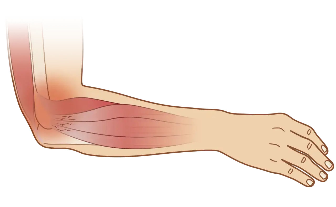 Illustration zeigt die Muskulatur des Unterarms, die bei einem Tennisarm wo Schmerzen auftreten k&ouml;nnen, detailliert.