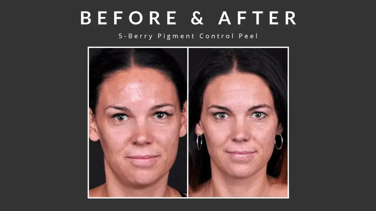 Przed i po zabiegu 5-Berry Pigment Control Peel. Widoczna poprawa kolorytu i tekstury skóry, co pokazuje, co to jest peeling.