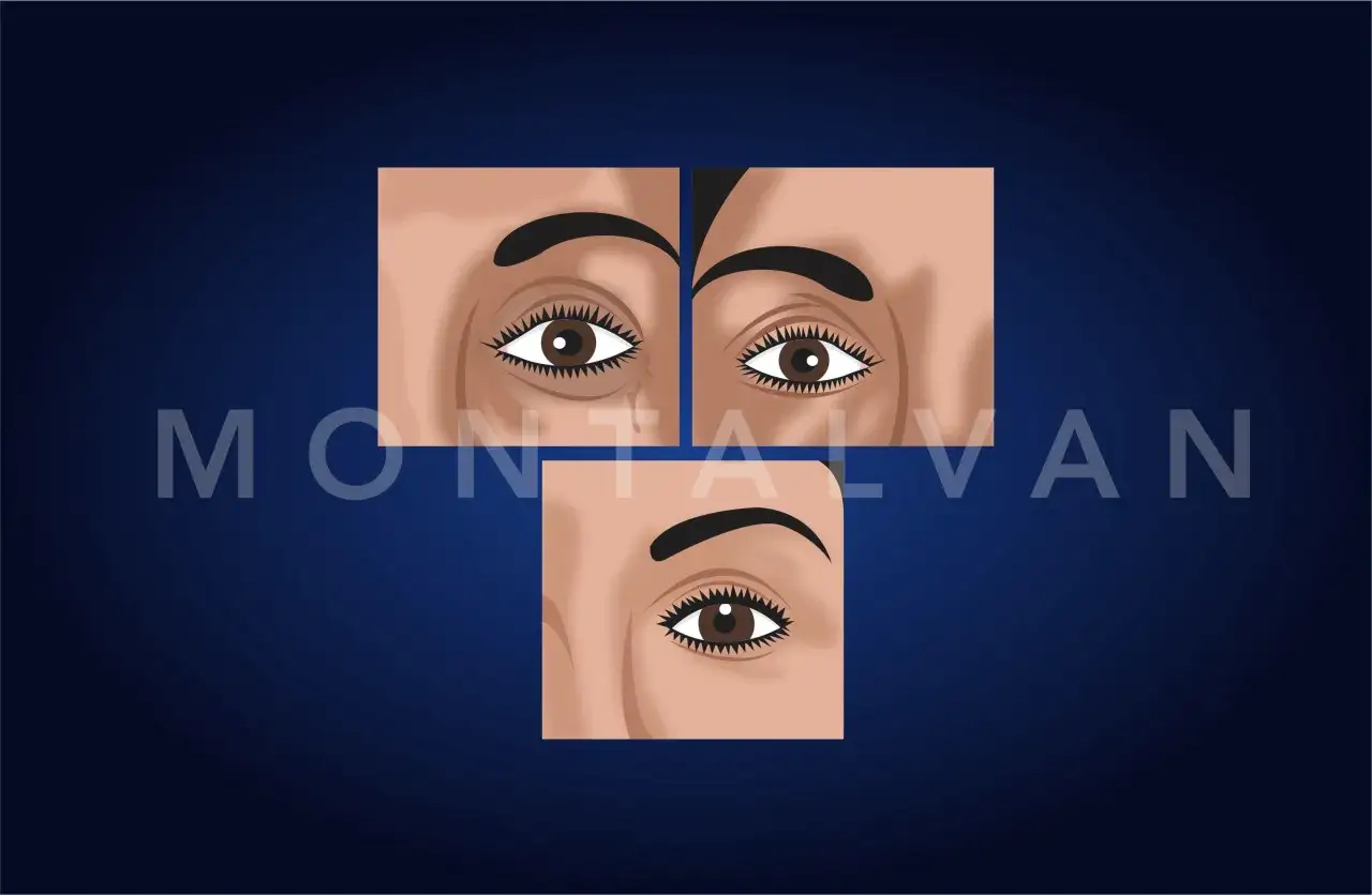 Tres primeros planos de ojos, uno inferior y dos superiores, mostrando la piel alrededor de los ojos hundidos.