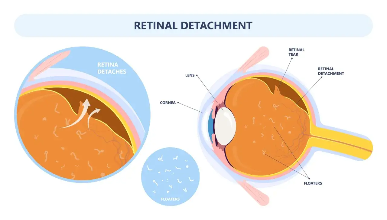 Illustrazione anatomica dell'occhio che mostra il distacco della retina, con aree che indicano lacerazioni e floaters. Vedere ombrato da un occhio.