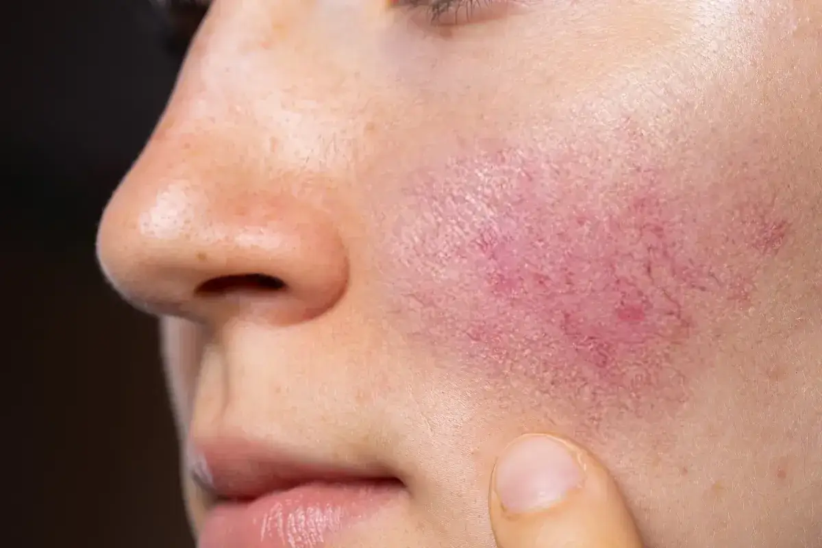 Skóra policzka z rumieniem, przypominającym motyla, który może być objawem **lupus**.