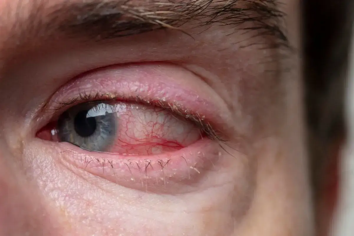 Silne zaczerwienienie oka i powieki, objawy alergicznego zapalenia spojówek. Widoczne drobne łuski u nasady rzęs.