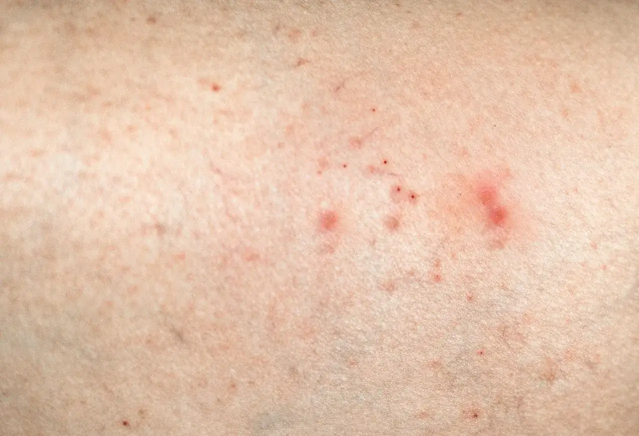 Skóra z zaczerwienieniami i drobnymi krostkami, objawy atopowego zapalenia skóry jak leczyć.