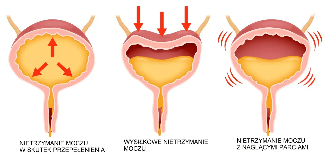 Ilustracja pokazuje trzy rodzaje inkontynencji moczu: przepełnienie, wysiłkowe i z nagłymi parciami.
