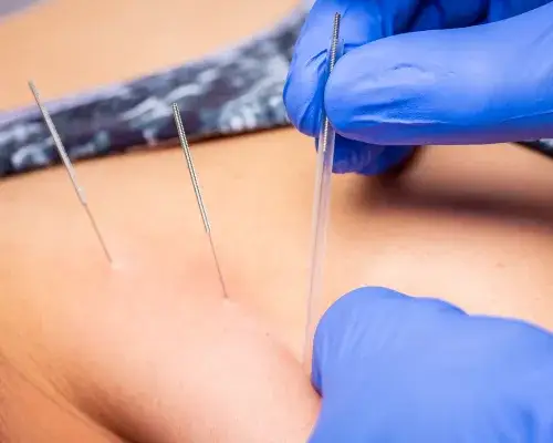 kinesiotaping suche igłowanie