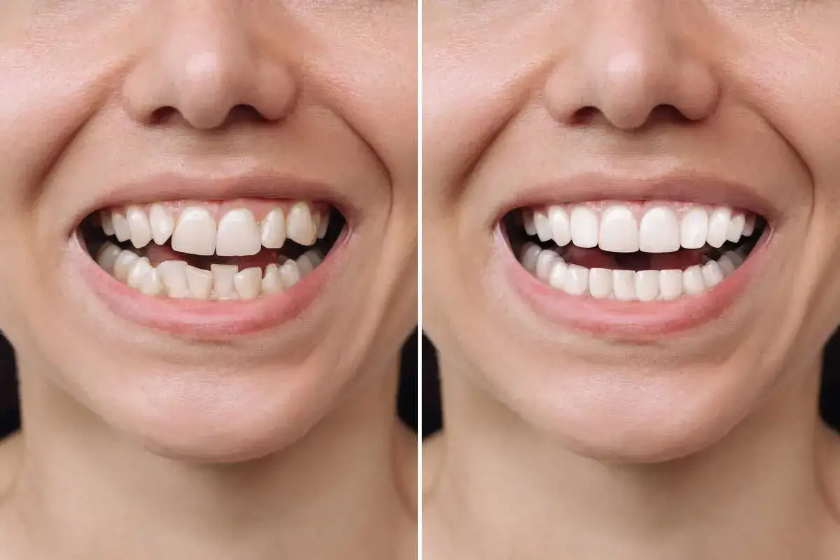 Uśmiech przed i po Invisalign: zęby wyrównane, proste i białe. Spektakularna metamorfoza!