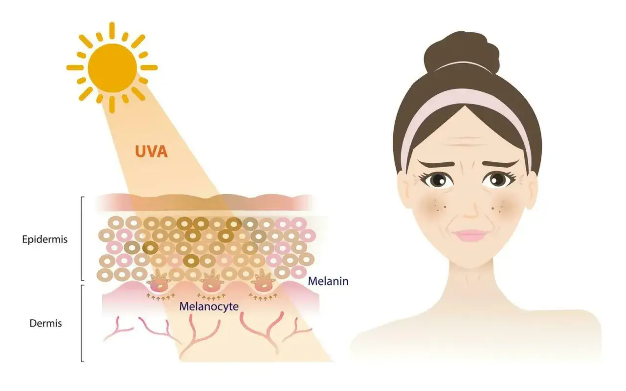 UVA-Strahlung beeinflusst Melanozyten in der Haut. Die Frage, wie lange bleibt man braun, hängt von der Melaninproduktion ab.